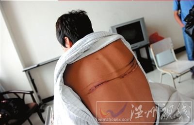 一名傷者背部至今還有明顯的傷疤。