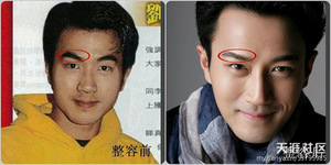 毛毛蟲(chóng)眉毛通過(guò)激光脫毛手術(shù)變疏密恰當(dāng)精致的劍眉整容部位：眉毛