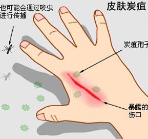 遼寧現炭疽病疫情
