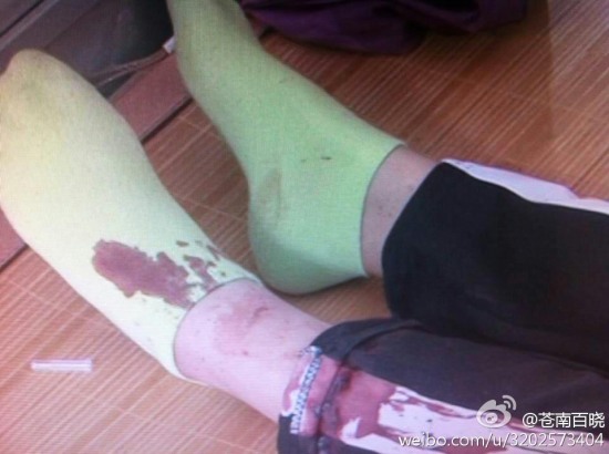 蒼南龍港第九中學女生用剪刀捅傷同學