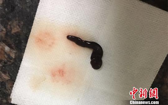 鼻腔取出5cm螞蝗