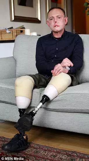 被愛犬舔舐后截肢